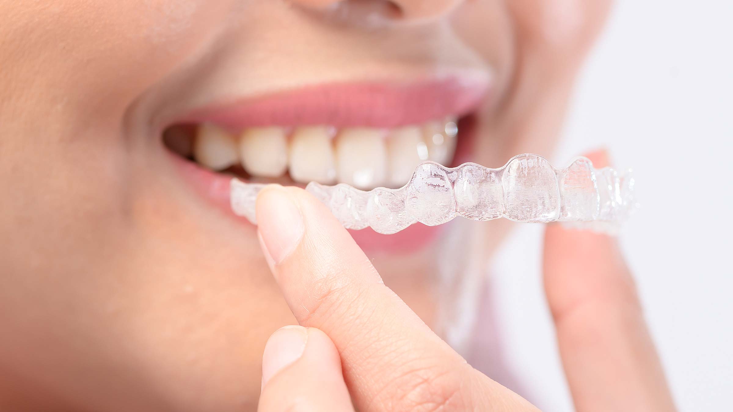 Clear Aligners