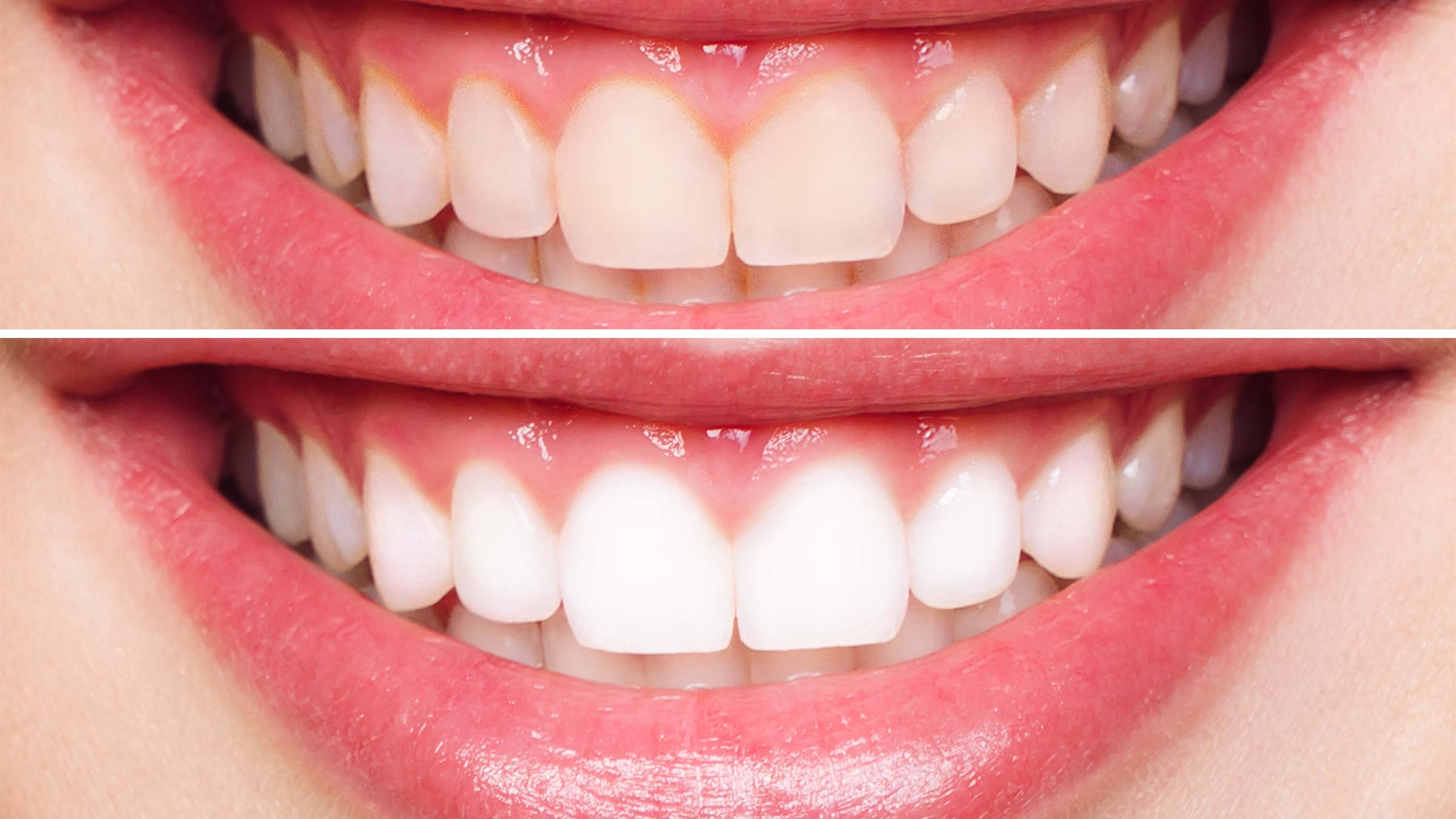Professional Teeth Whitening Systems